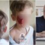 Собака депутата покусала ребёнка. Глава СК взял дело на контроль