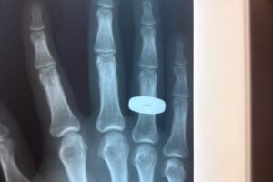 Жених из Балаково с переломом пальца спас девушку из кювета и успел на банкет