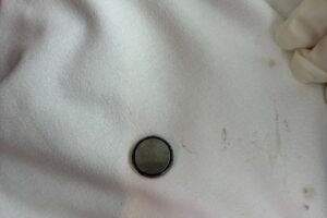 Врачи из Балаково спасли годовалого ребенка, проглотившего батарейку