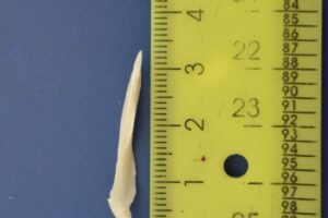 В балаковской больнице спасли пациента, проглотившего рыбную кость