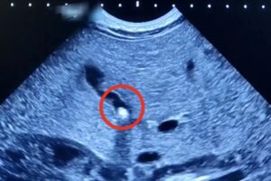 Балаковские врачи нашли камень в желчном пузыре у полуторамесячного малыша