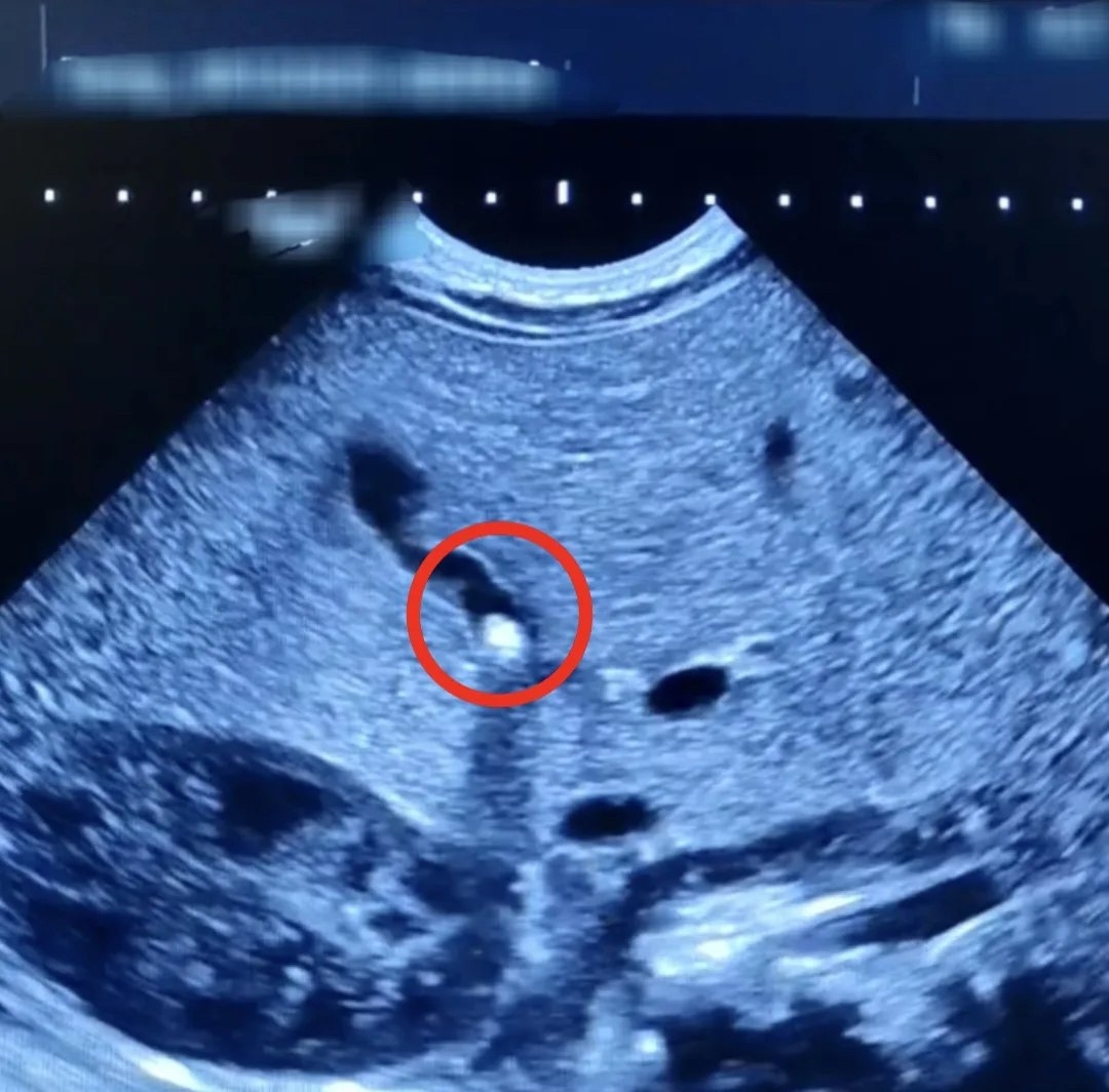 Балаковские врачи нашли камень в желчном пузыре у полуторамесячного малыша