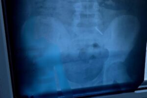 Балаковский школьник проглотил циркуль и попал в больницу