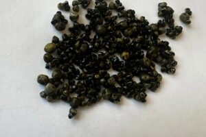 Каменный букет в здоровом теле. 50-летняя пациентка удивила балаковских хирургов