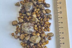 Балаковские хирурги удалили «каменный» желчный пузырь пожилой пациентке