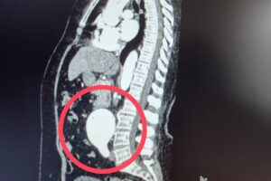 Балаковские хирурги провели уникальную операцию