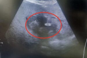 Балаковские врачи спасли 83-летнюю пациентку