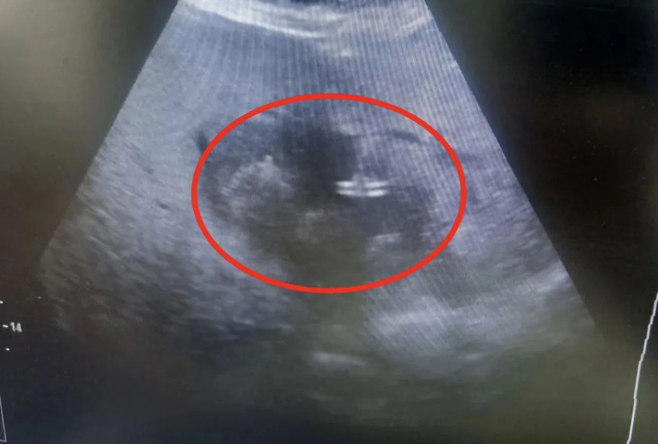 Балаковские врачи спасли 83-летнюю пациентку