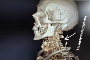 Балаковские хирурги вернули мужчину из паралича за 19 дней