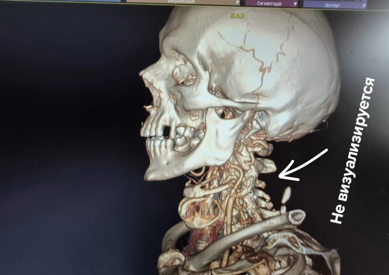 Балаковские хирурги вернули мужчину из паралича за 19 дней